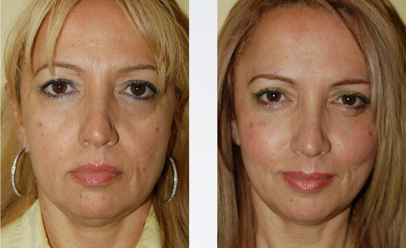 eliminar lineas de expresion de la sonrisa