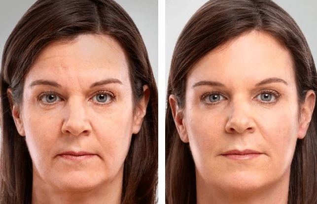 Esto me sucedió probando Gimnasia Facial de Mariana Azcuénaga 3